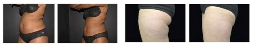 Coolsculpting